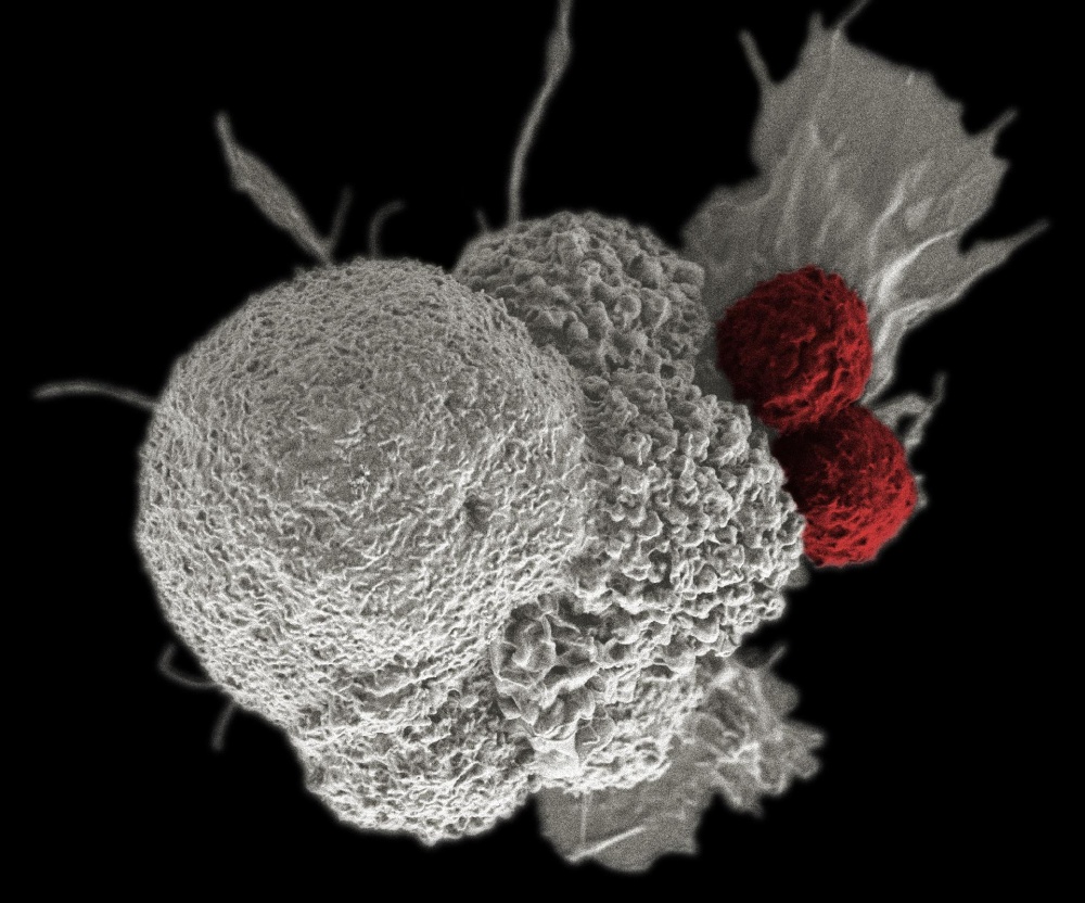A felébresztett immunrendszer kisöpri a daganatot